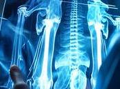 REPOSITIONNEMENT antipaludique contre l'ostéoporose