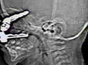 enfant mois survit après s'être planté dans l'oeil