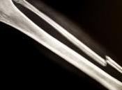 Nouvelle piste traitement l'ostéoporose