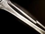 injections cellules osseuses pour réparer fractures plus vite