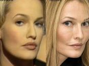 L'ex-top model Karen Mulder defigurée chirurgie esthétique