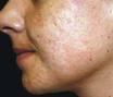 Comment combattre l'acné