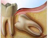 Auto-transplantation d'une dent sagesse alternative naturelle l'implant dentaire