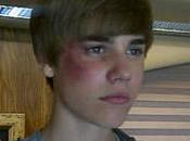 Justin Bieber oeil beurre noir, s'est-il battu (PHOTO)