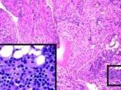 MYOCARDITE: scientifiques trouvent cause cette inflammation mortelle muscle cardiaque Journal Clinical Investigation