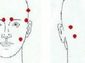 MIGRAINE: Botox réduit crises, leur fréquence, durée European Journal Neurology