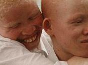 consultations gratuites pour albinos dans hôpitaux