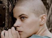 Problème calvitie chez hommes femmes