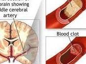 TABAGISME: Fumer, c’est l’AVC avant non-fumeurs Canadian Stroke Congress