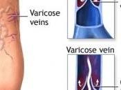 VARICES: Découverte d’une protéine impliquée dans maladie veineuse FASEB Journal