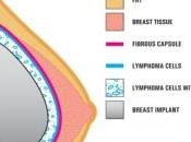 IMPLANTS MAMMAIRES: risque lymphome existe, quel soit type d’implant Sécurité sanitaire-