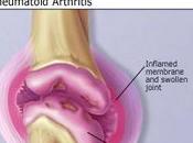 Bouts faciles pour soulagement douleur normal d'arthrite