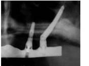 Implants dentaires avec d'os première