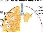 Journée mondiale LAM: femmes France attendent traitement Association FLAM