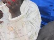 malnutrition aigüe dans Comté sud-soudanais Twic