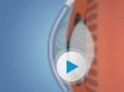 GLAUCÔME: Découverte d’un indice précoce risque Ophthalmology