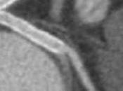 Ballonnets élution Paclitaxel, stents imprégnés Paclitaxel angioplastie ballonnet chez patients atteints resténose après implantation d’un stent imprégné médicament (ISAR-DESIRE étude ouverte randomisée
