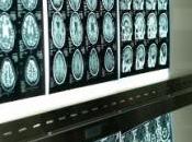 SCHIZOPHRÉNIE: seul gène fait différences énormes Molecular Psychiatry