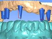 Prothèses fixées implant l'heure numérique