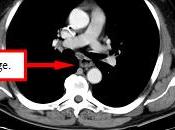 Chimiothérapie avec sans cetuximab chez patients atteints cancer l’œsophage (SCOPE1) étude multicentrique, phase 2/3, randomisée