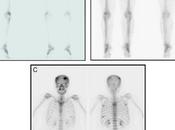 Efficacité sécurité l’administration d’acide zolédronique semaines versus pour traitement prolongé chez patientes atteintes métastases osseuses provenant d’un cancer sein (ZOOM) étude non-infériorité pha...