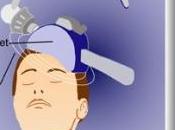 AVC: stimulation cérébrale pour récupérer contrôle parole Stroke