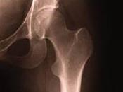 ARTHROPLASTIE HANCHE: Chute taux décès suite l'intervention Lancet