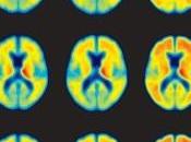 manque SOMMEIL associé risque d'Alzheimer JAMA Neurology
