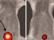 THROMBOSE: Vers test d'urine pour détecter caillots Nano