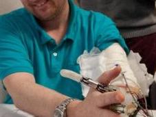 Amputation Première prothèse main avec sens toucher intégré