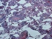 Rituximab après traitement conditionnement lymphome transplantation cellules souches allogéniques pour d’un non-Hodgkinien, récidivant réfractaire agressif (SDHNHL essai phase ouvert randomisé