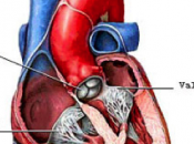 Innovation dans remplacement valve aortique (TAVI)