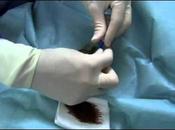 Gastrostomie percutanee endoscopique (gpe)