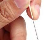 MÉNOPAUSE: d'acupuncture contre bouffées chaleur Menopause