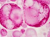 Combinaison cediranib d’olaparib versus olaparib seul chez femmes atteintes cancer l’ovaire récidivant sensible platine étude phase randomisée