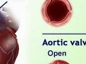 #thelancet #sténoseaortique #valvuleaortique #voietransfémorale Résultats d’un remplacement transcatheter d’une valvule aortique comparaison traitement standard chez patients atteints sténose opérable (PARTNER e...