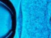 FIV: Ovocytes congelés mais jusqu'à quel âge? European Society Human Reproduction Embryology