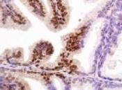 CANCER PROSTATE: signatures génétiques identifiées pour traitements ciblés EBioMedicine