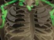 OBÉSITÉ: implants graisse brune pour bloquer prise poids Diabetes