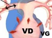 HYPERTENSION PULMONAIRE: n'est contre-indication l'exercice physique! Circulation: Heart Failure