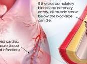 CRISE CARDIAQUE: Pourquoi patients cardiaques doivent fuir pollution