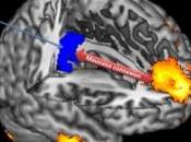 COMA: Quand zones cerveau déconnectent Inserm Neurology