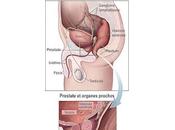 #thelancetoncology #cancerdelaprostate #enzalutamide #bicalutamide Efficacité innocuité d’enzalutamide versus bicalutamide chez patients atteints cancer prostate métastasé (TERRAIN) essai phase randomisé double aveugle