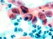 CANCER l’UTÉRUS: 10ème semaine européenne prévention CHRU Tours