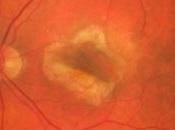 DMLA: promesses statines pour rétablir l'acuité visuelle EBioMedicine
