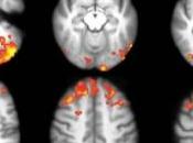 SCLÉROSE plaques: jeux vidéo redonnent plasticité cérébrale Radiology