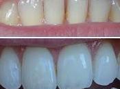Blanchir dents avec Crest