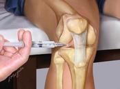 ACIDE HYALURONIQUE: Principe d’action injections intra-articulaires Santé Orthopédique