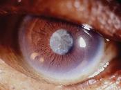 Cataracte définition symptômes