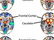 PHOBIES: L'exposition inconsciente stimuli, meilleure thérapies? Human Brain Mapping